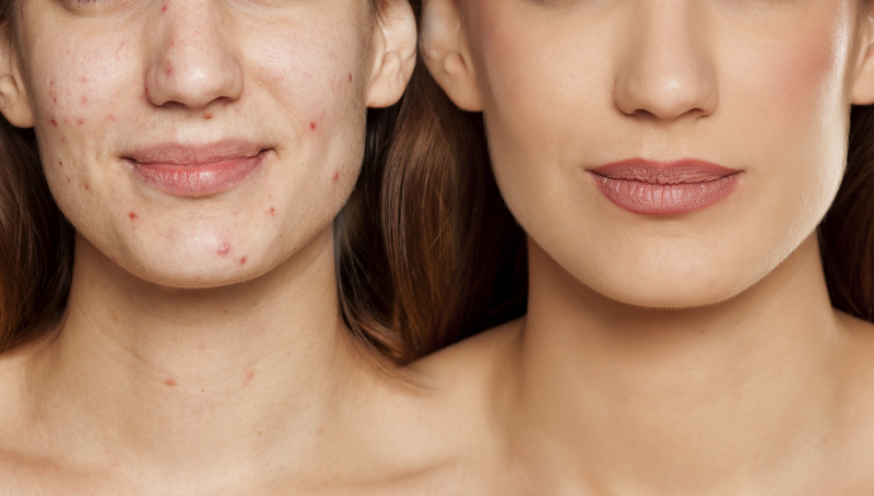 Micro Needling for Acne Scars-richmond victoria-miss morpho