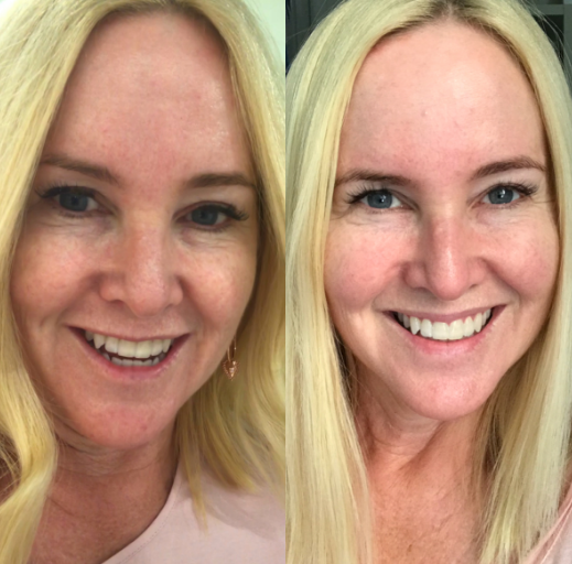 Pro power peel facial-richmond victoria-miss morpho