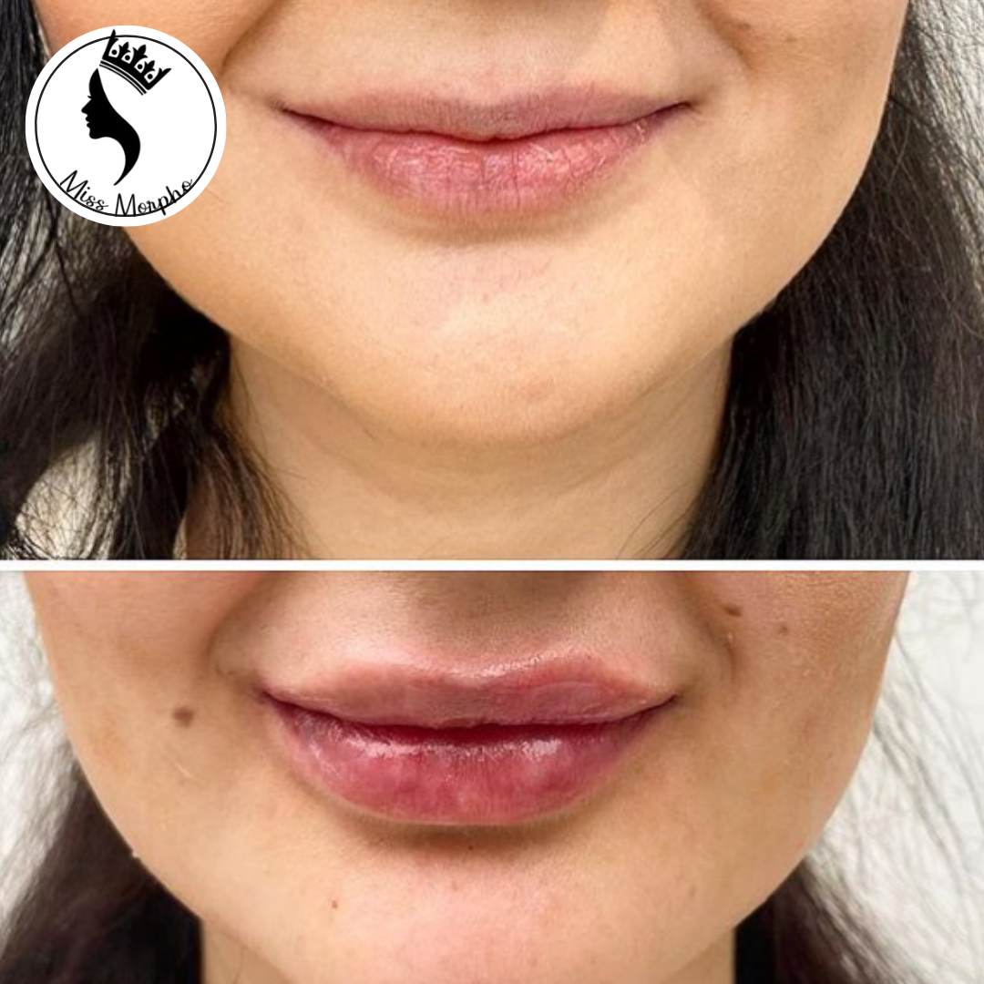 Lip Fillers-Richmond Victoria-Australia-Mi